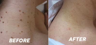 Концентрований потужний крем для видалення вугрів Концентрований потужний крем для видалення вугрів