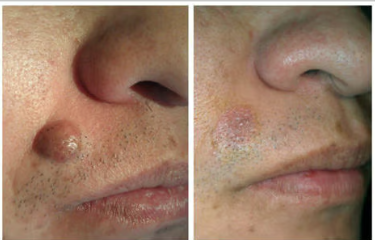 Концентрований потужний крем для видалення вугрів Концентрований потужний крем для видалення вугрів