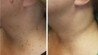 Концентрований потужний крем для видалення вугрів Концентрований потужний крем для видалення вугрів